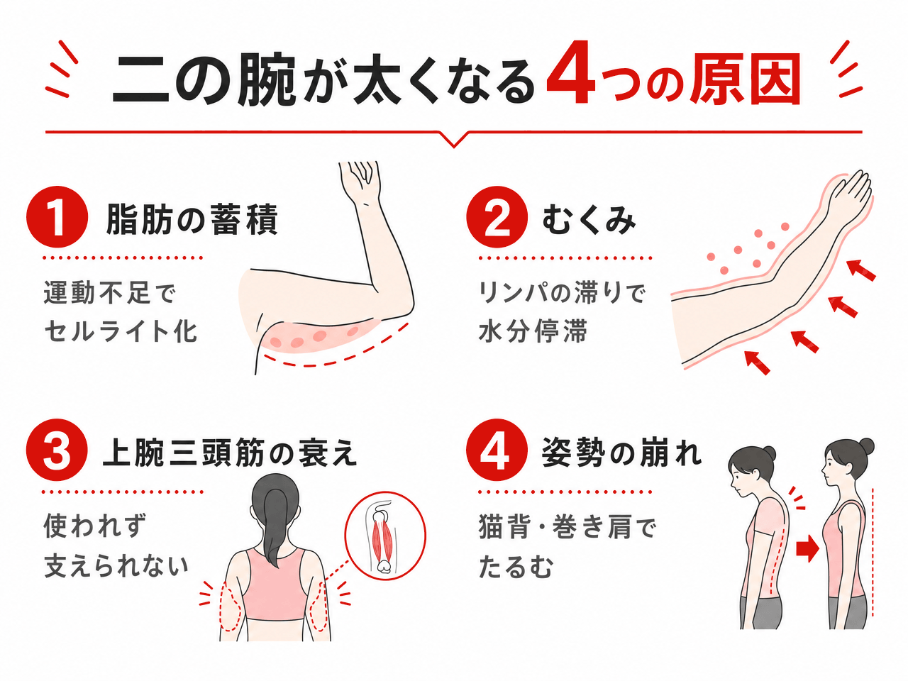 二の腕が太くなる4つの原因の図解。①脂肪の蓄積(運動不足でセルライト化)②むくみ(リンパの滞りで水分停滞)③上腕三頭筋の衰え(使われず支えられない)④姿勢の崩れ(猫背・巻き肩でたるむ)