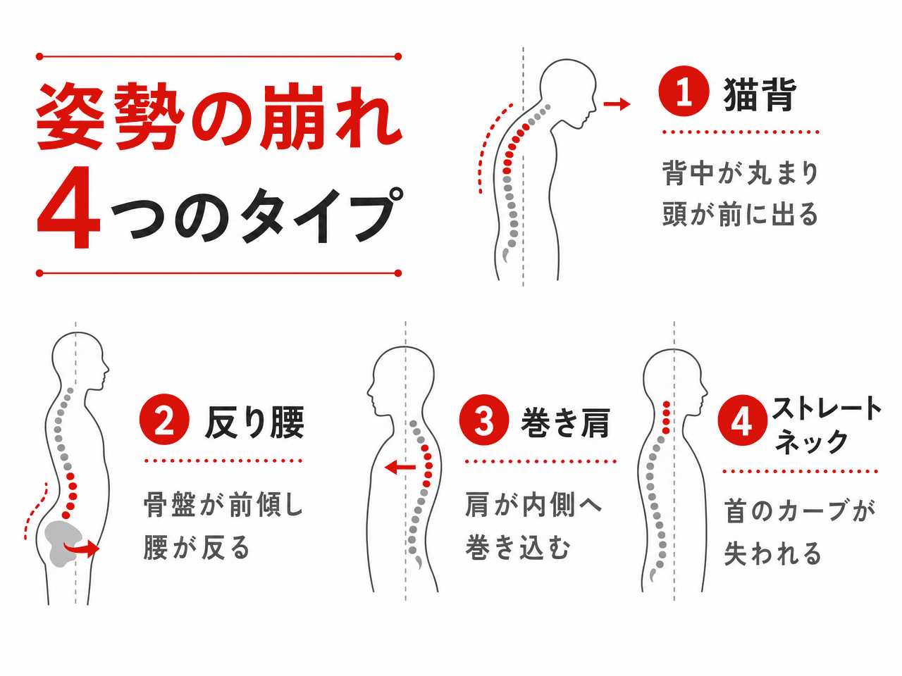 姿勢の崩れ4つのタイプの図解。①猫背＝背中が丸まり頭が前に出る、②反り腰＝骨盤が前傾し腰が反る、③巻き肩＝肩が内側へ巻き込む、④ストレートネック＝首のカーブが失われる。各タイプを横から見た背骨のラインで示している。